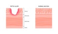 Peptic ulcer disease