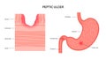 Peptic ulcer disease