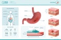 Peptic ulcer and helicobacter pylori infographic Royalty Free Stock Photo