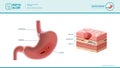 Peptic ulcer medical illustration