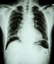 Peptic ulcer perforate . ( film chest x-ray show free air under dome of both diaphragm due to air leak from gastric ulcer or Royalty Free Stock Photo