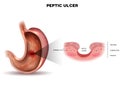 Peptic ulcer