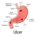 Peptic ulcer of the stomach, microscopic colorful anatomy on a white background. Medical vector illustration with all internal Royalty Free Stock Photo