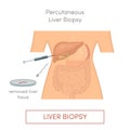 Percutaneous liver biopsy Royalty Free Stock Photo