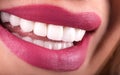 Perfect Close Up White beautiful Veneers Teeth bleaching crowns whitening young lady smiling, Sensual sexy Seductive plump Lips