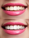 Perfect smile before and after bleaching. Dental care and whitening teeth Royalty Free Stock Photo