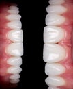 Perfect smile before and after bleaching procedure whitening of zircon arch ceramic prothesis Implants crowns. Dental restoration