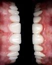 Perfect smile before and after bleaching procedure whitening of zircon arch ceramic prothesis Implants crowns. Dental restoration