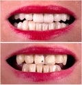 Perfect smile before and after bleaching procedure whitening of zircon arch ceramic prothesis Implants crowns. Dental restoration