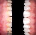 Perfect smile before and after veneers bleach of zircon arch ceramic prothesis Implants crowns. Dental restoration treatment