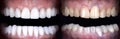Perfect smile whitening before and after veneers bleach of zircon arch ceramic prothesis . Implants crowns. Dental restoration tre Royalty Free Stock Photo