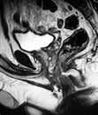 Perianal fistula abscess acute pathology mri exam