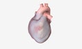 Pericardial effusion is a cardiac condition characterized by fluid buildup outside the heart