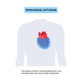 Pericardial effusion heart