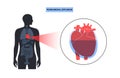 Pericardial effusion heart