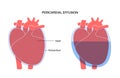 Pericardial effusion heart