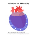 Pericardial effusion heart