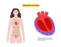 Pericardial effusion heart