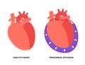 Pericardial effusion heart