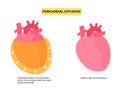 Pericardial effusion heart