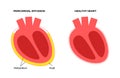 Pericardial effusion heart