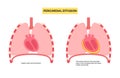 Pericardial effusion heart