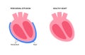 Pericardial effusion heart