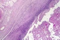 Pericarditis, light micrograph, photo under microscope Royalty Free Stock Photo