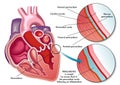 Pericarditis Royalty Free Stock Photo