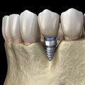 Periimplantitis with visible bone reduction. Medically accurate 3D illustration of dental implants concept Royalty Free Stock Photo