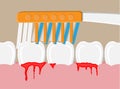 Periodontal disease, bleeding gums