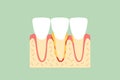 Periodontal disease or gingivitis of incisor tooth