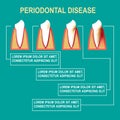 Periodontal disease Vector illustration