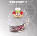 Periodontitis bacteria enters in to the blood