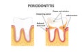 Periodontitis, dental disease.
