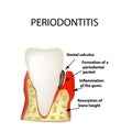 Periodontitis. dental disease. Inflammation of the gums and the