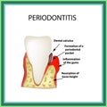 Periodontitis. dental disease. Inflammation of the gums and the