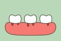 Periodontitis or gum disease with bleeding blood flow come from gum and tooth , dental problem