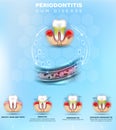 Periodontitis gum disease