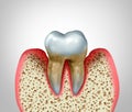 Periodontitis