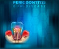 Periodontitis gum disease poster