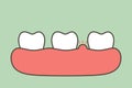 Periodontitis or gum disease with swell - teeth cartoon vector flat style