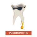Periodontitis ill tooth dentistry mouth cavity disease