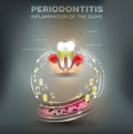 Periodontitis