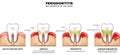 Periodontitis