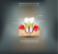 Periodontitis Royalty Free Stock Photo