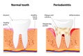 Periodontitis Royalty Free Stock Photo