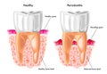 Periodontitis Royalty Free Stock Photo