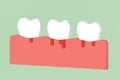Periodontitis or periodontal disease with bleeding, inflammation of the gum tissue around the teeth