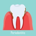 Periodontitis problem, gum sick. Illustration of human tooth with dental inflammation isolated Royalty Free Stock Photo